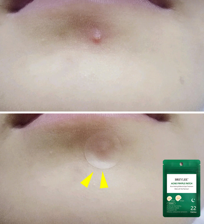 Acne Stickers, Night Acne Stickers, Fade Acne Marks