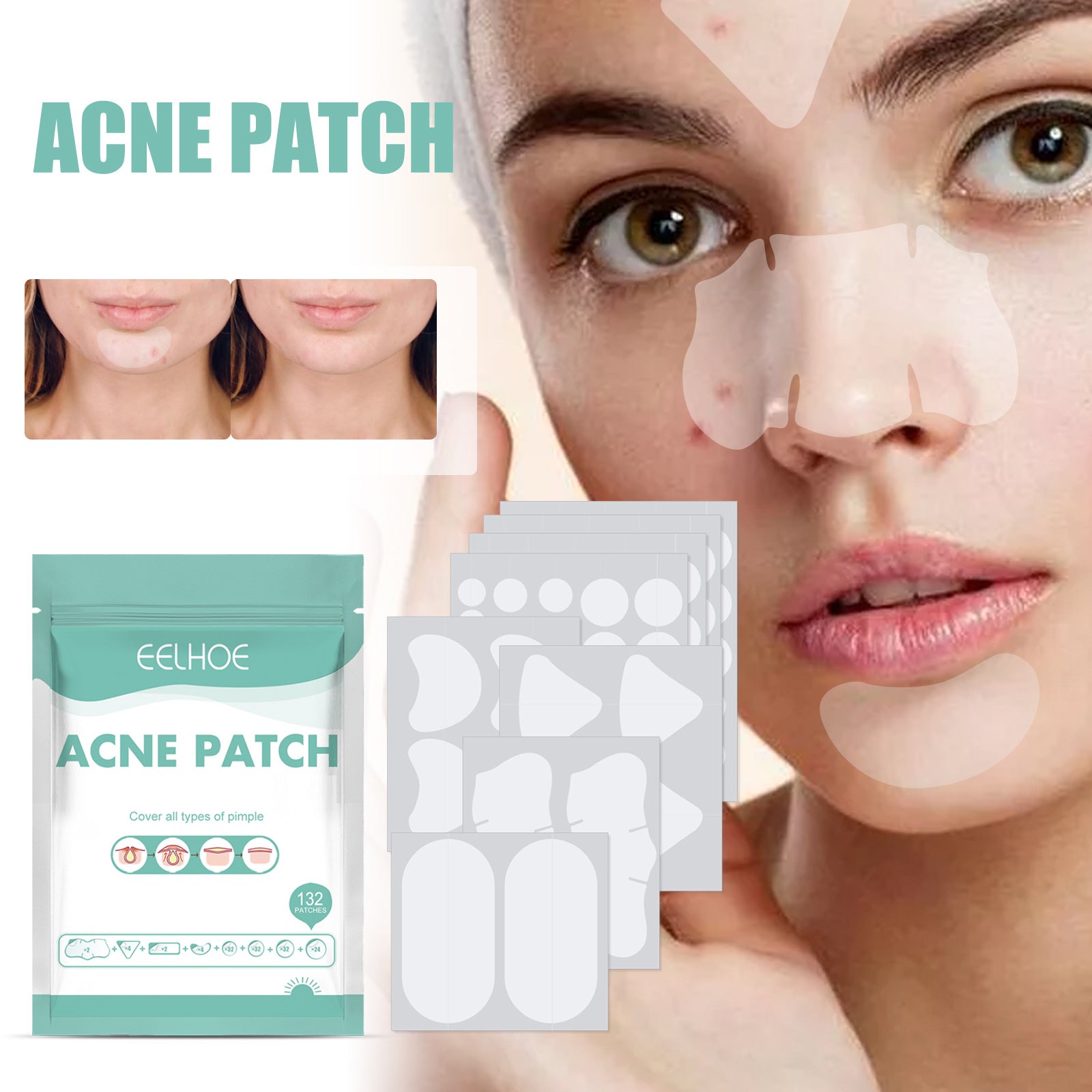EELHOE Acne Relief Mask Patch Is a Gentle, Non-Irritating Acne Mask That Helps to Reduce Acne Marks and Heal Acne.