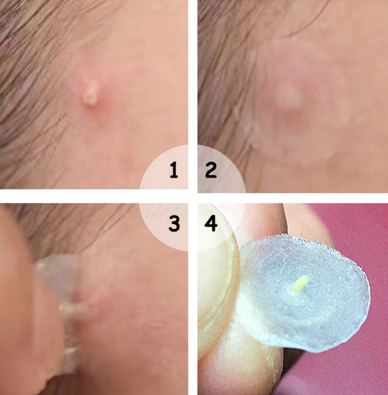 Acne Stickers, Night Acne Stickers, Fade Acne Marks