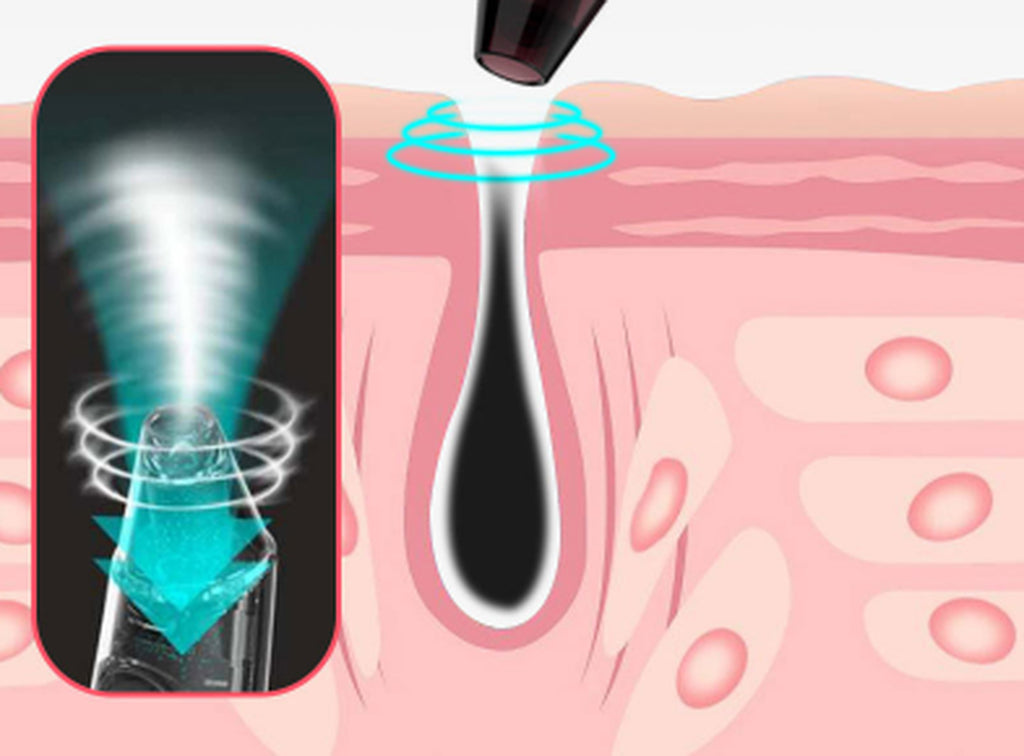 Visual Blackhead Acne Remover to Suck Blackheads